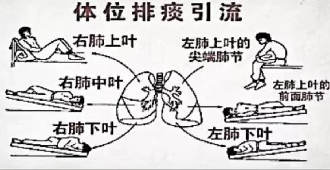 体位引流示意图原图